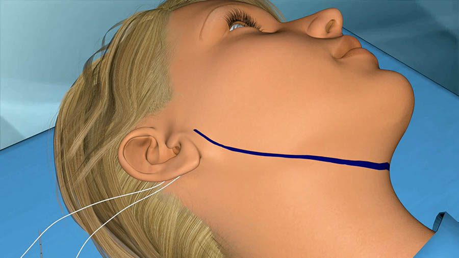 Elastic lifting of the neck with an incision of 1 cm behind a lobe of an ear