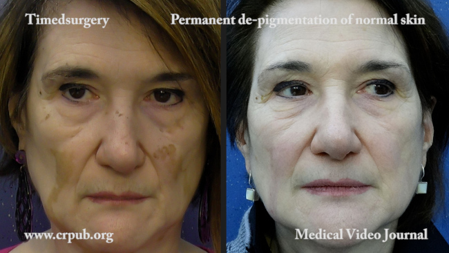 24. Permanent de pigmentation with timedsurgical mixed peeling of normal facial skin in vitiligo universalis