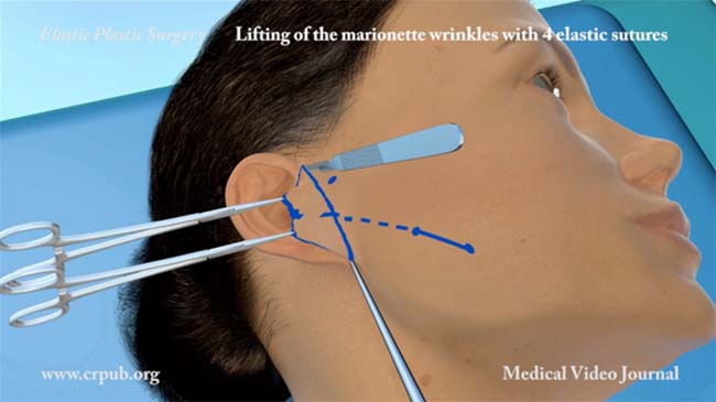 57. Lifting marionette wrinkles with 2 or 4 elastic threads and removal of the preauricular skin