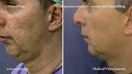 Acne scars treating with intradermal Adipofilling