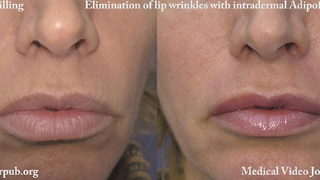 Adipofilling  Elimination of lip wrinkles 