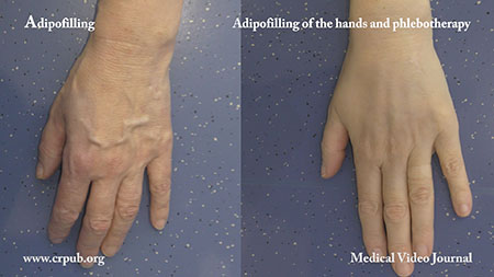 Adipofilling of the hands and Phlebotherapy