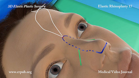 Elastic Lifting of the Nose with thread news