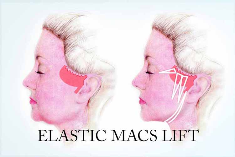 Elastic Macs Neck lift minimal scar and dissection