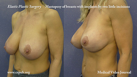 Mastopexy of breast with implants by elastic threads