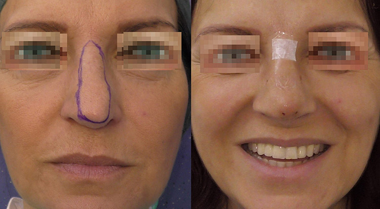 Tip of the nose correction with elastic thread before and after ok