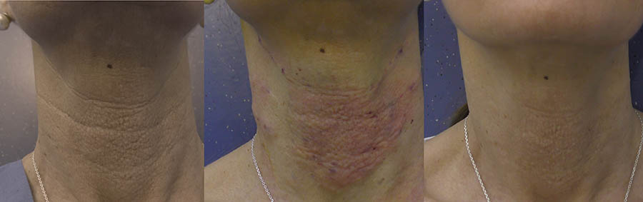 Intradermal Adipofilling before and after 20 days