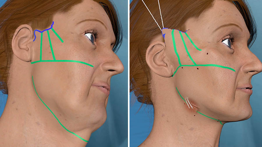 Elastic MACS and Neck lift. Incision that stops at the tragus. Dissection that slightly exceeds the zygomatic arch. Excess skin removal