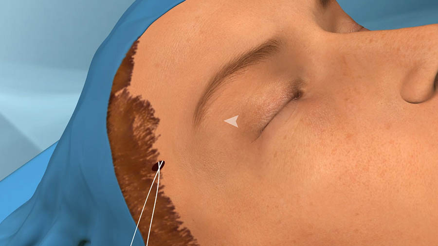 Elastic lifting of eyebrows with an incision of a few millimeters to the hairline
