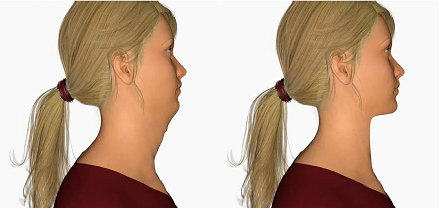 Liposuction and elastic lifting of the neck