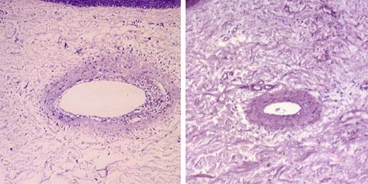 Phlebotherapy Histology