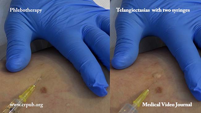 10. Phlebotherapy of telangiectasias and micro telangiectasias with the two syringe technique