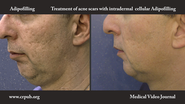 11. Cellular Adipofilling for acne scar