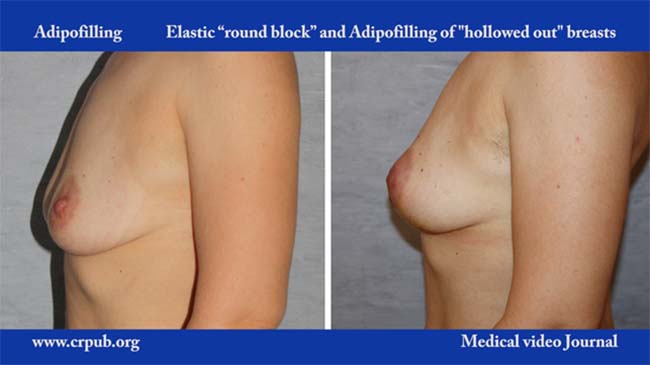 12. Elastic round block and Adipofilling of hollowed out breasts, without skin excision