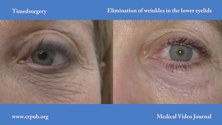 Elimination of wrinkles in the lower eyelids