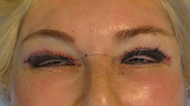 20. Upper blepharoplasty after elastic canthopexy