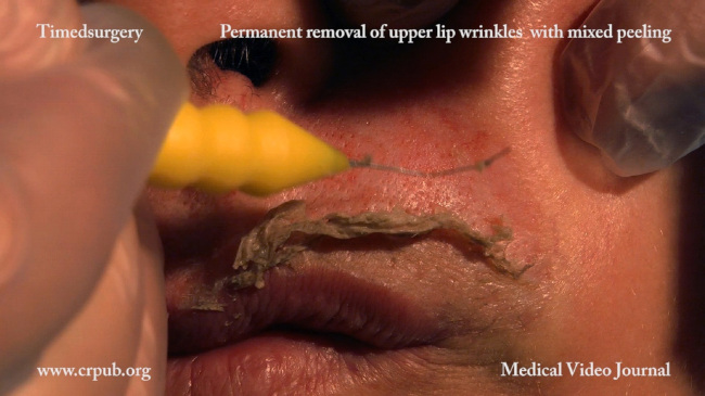 21. Permanent removal of upper lip wrinkles and treatment of a residual wrinkle with timedsurgical mixed peeling de epithelialization and application of resorcin