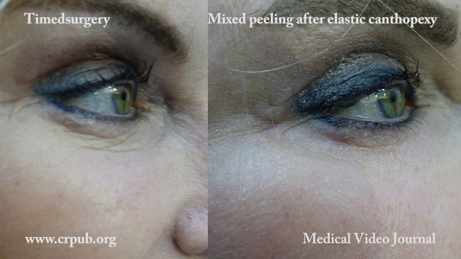 22. Mixed peeling of the lower eyelids after elastic canthopexy and upper blepharoplasty