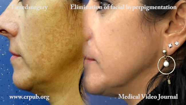 23. Elimination of facial hyperpigmentation by means of Electroporo Cosmesis and 0.5 mixed peeling