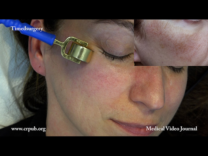 25. Treatment of a superficial skin angioma of the face with Electroporo Cosmesis