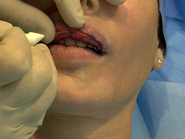 26. Rapid pulsed timedsurgical cutting to remodel lip deformities due to over injection of silicone oil