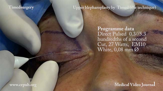 27. Upper blepharoplasty by means of the Timed apparatus