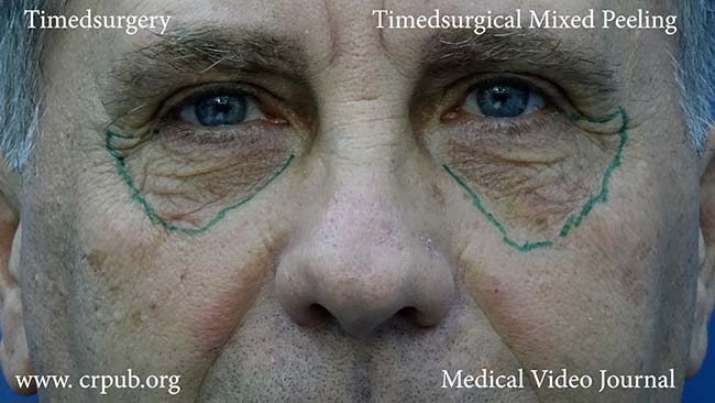 29. Elimination of the roughness of the lower eyelid with mixed peeling