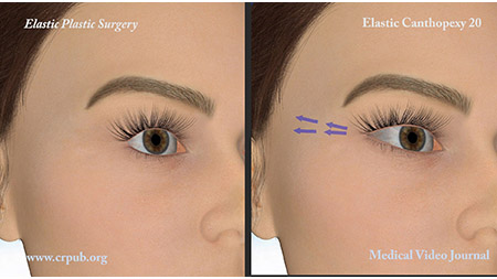 3D Elastic Cantopexy before and after