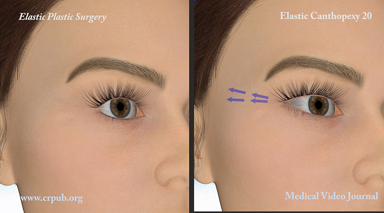 3D Elastic Cantopexy before and after