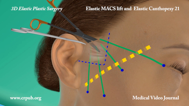 51. Elastic MACS lift and elastic Canthopexy