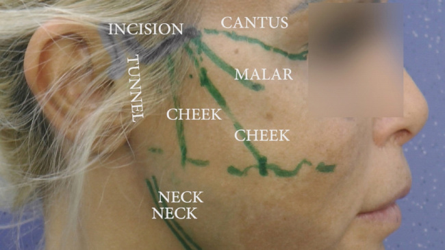 53. Elastic canthopexy in elastic MACS and neck lifting with subsequent Adipofilling