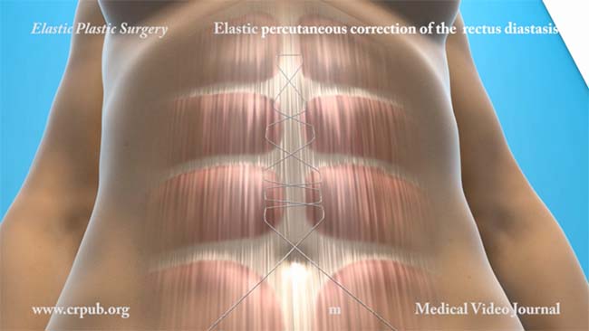 54. Percutaneous correction of the diastasis of the rectus abdominis muscles with the Elasticum suture and the two pointed needle