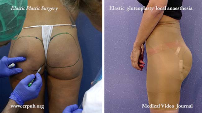 55. Local anesthesia in elastic gluteoplasty