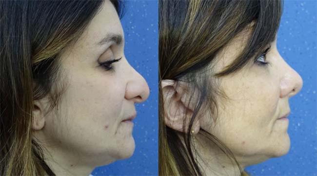 56. Elastic rhinoplasty with removal of a cartilaginous hump and correction of the anterior septum