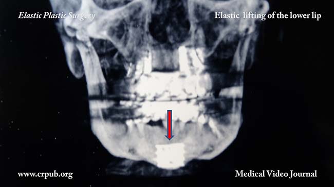 59. Elastic lifting of the lower lip