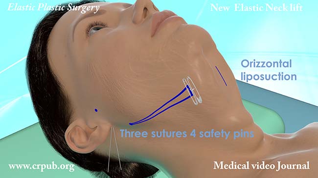 60. Elastic neck lift with three sutures and 4 safety pins
