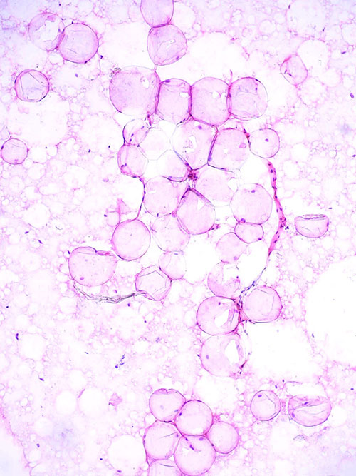 Adipofilling histologic smear