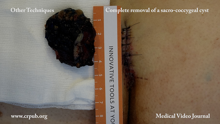 Complete removal of a sacro coccygeal cyst and immediate skin suture