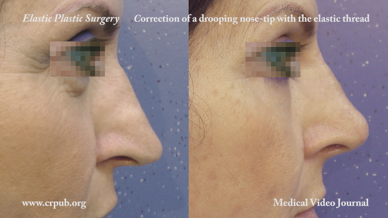 Correction of a drooping nose tip