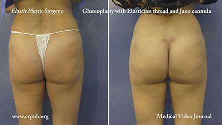 ELASTIC GLUTEOPLASTY