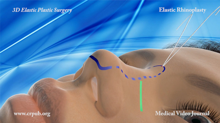 Elastic rhinoplasty - Dr. Sergio Capurro