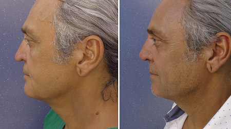 Elastic rhinoplasty with the elastic thread