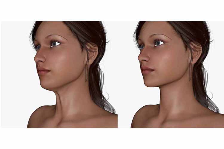 Elastic lifting of the Lower Neck procedure