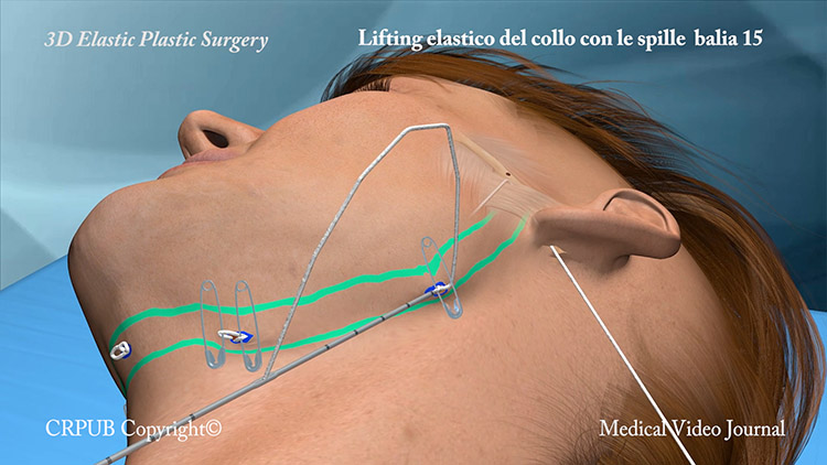 Lifting del collo con i fili elastici e le spille da balia