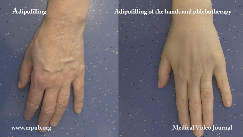 Rejuvenating the hands