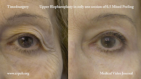 Upper Blepharoplasty in one 0.5 mixed peeling