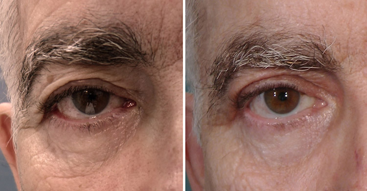 Upper blepharoplasty with timedsurgical mixed peeling 0.5