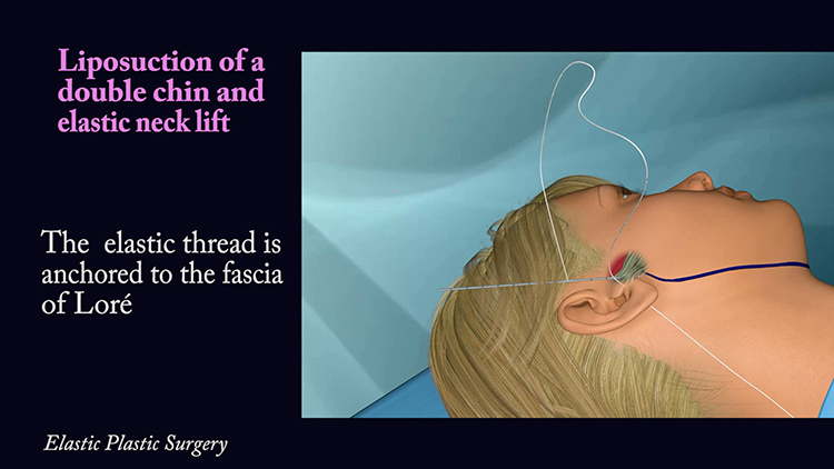 Liposuction of a double chin and simultaneous elastic neck lifting through an 8 mm incision