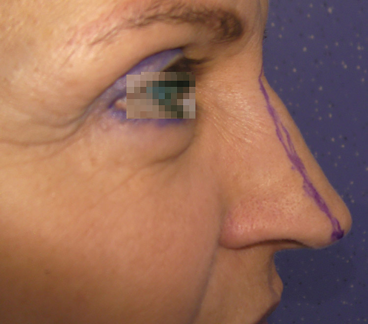 tip of the nose correction with elastic thread