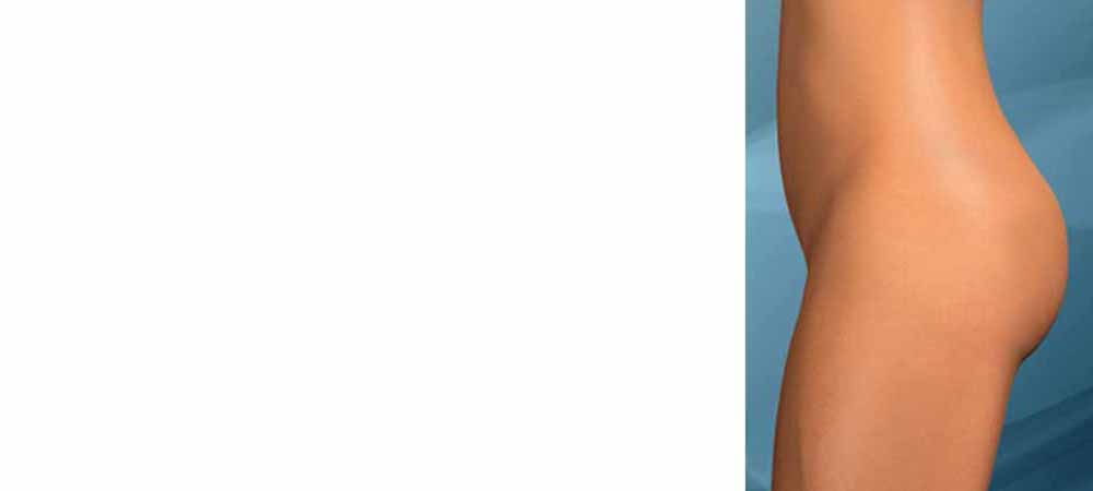 Il dr. Capurro ha rivoluzionato la chirurgia estetica con i
LIFTING ELASTICI DEL CORPO
AMBULATORIALI - SENZA SCOLLAMENTO - INCISIONI DI POCHI MM
Sollevamento  elastico del sedere (Gluteoplastica elastica)
Sollevamento elastico delle mammelle ptosiche (Mastopessi elastica)
Conizzazione elastica delle mammelle con impianto di silicone
Conizzazione e mastopessi delle mammelle con impianto di silicone.


Capurro Philosophy
La sutura elastica dotata di ago a due punte ideata dal dr. Capurro attraverso una incisione di 8 mm è in grado di sollevare e compattare i glutei senza eseguire scollamenti cutanei. 
Due incisioni di pochi millimetri sono in grado di sollevare le mammelle (Mastopessi elastica).
Una incisione periareolare di 8 mm è in grado di rendere più naturali le mammelle con gli impianti di silicone. Il filo elastico conizza le mammelle e  riposiziona l'impianto a contatto con la parete toracica eliminando l'aspetto di palla nella calza. Attraverso un'altra piccola incisione le mammelle con gli impianti di silicone possono essere sollevate.